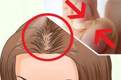 problemas com cabelos e unhas devido a parasitas